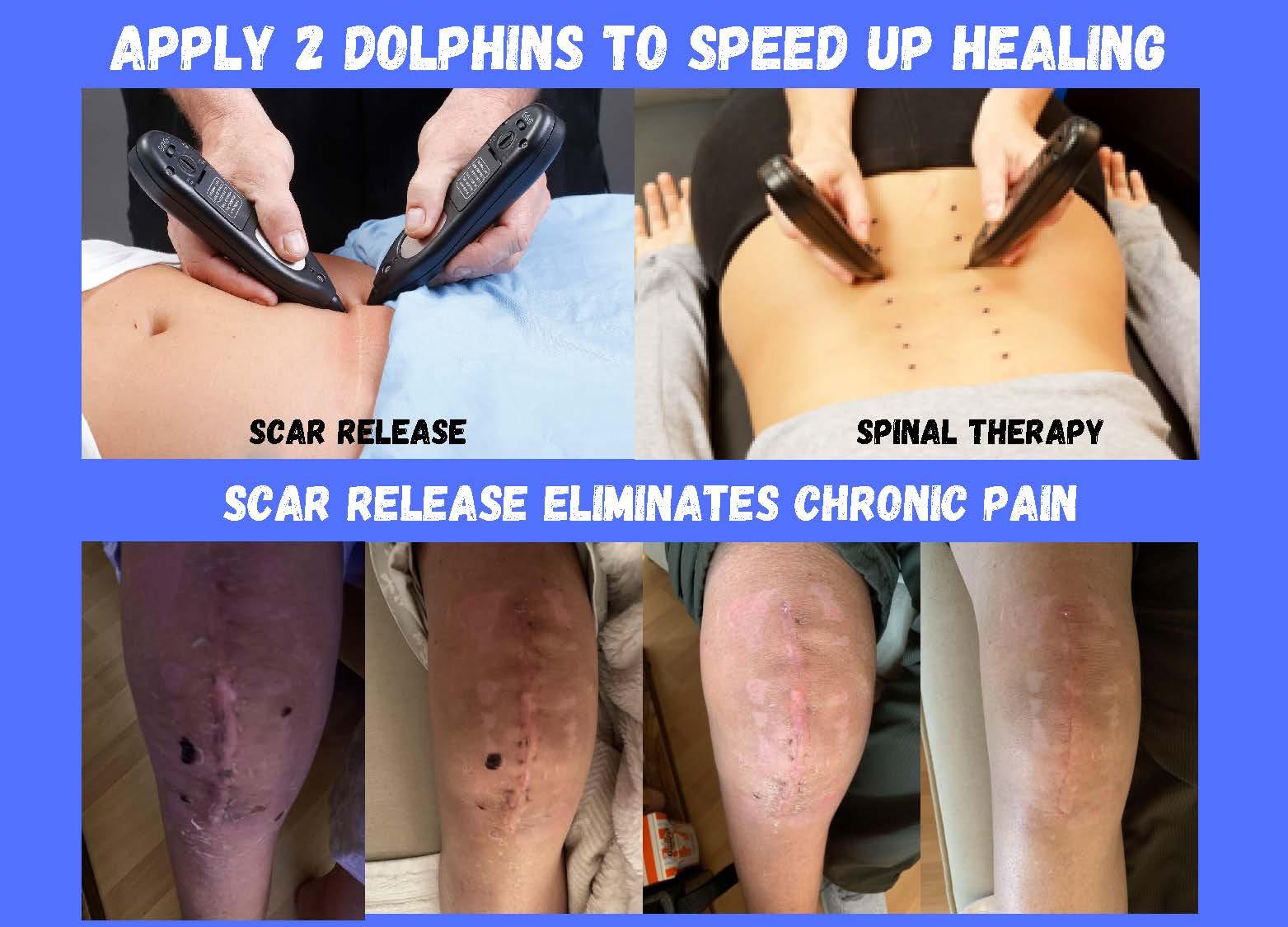 Scar Release Therapy using Dolphin device