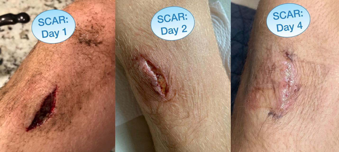Before and After scar treatment